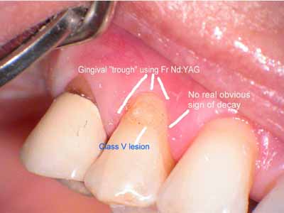 Laura Gingival trough1.jpg